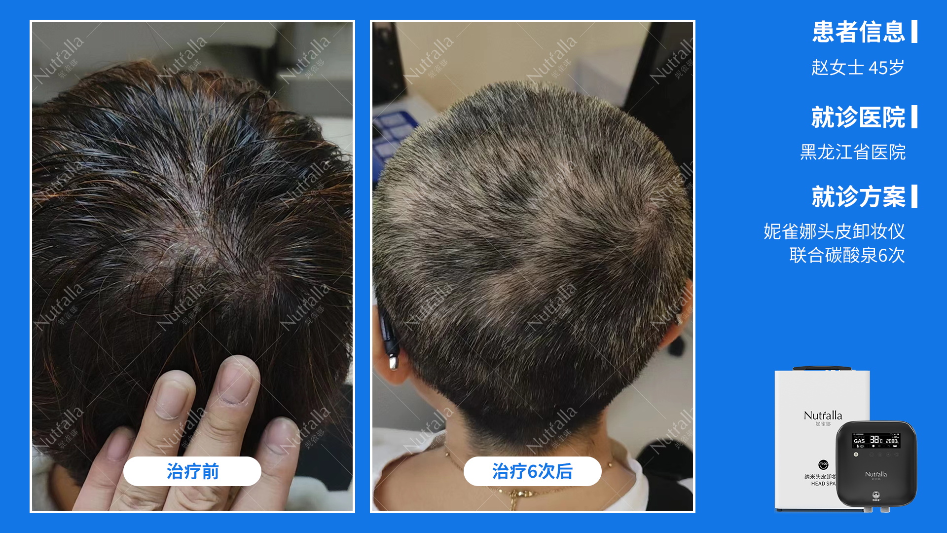 黑龙江省医院 患者 女45岁 重度脂溢性皮炎 头皮卸妆仪加碳酸泉治疗6次