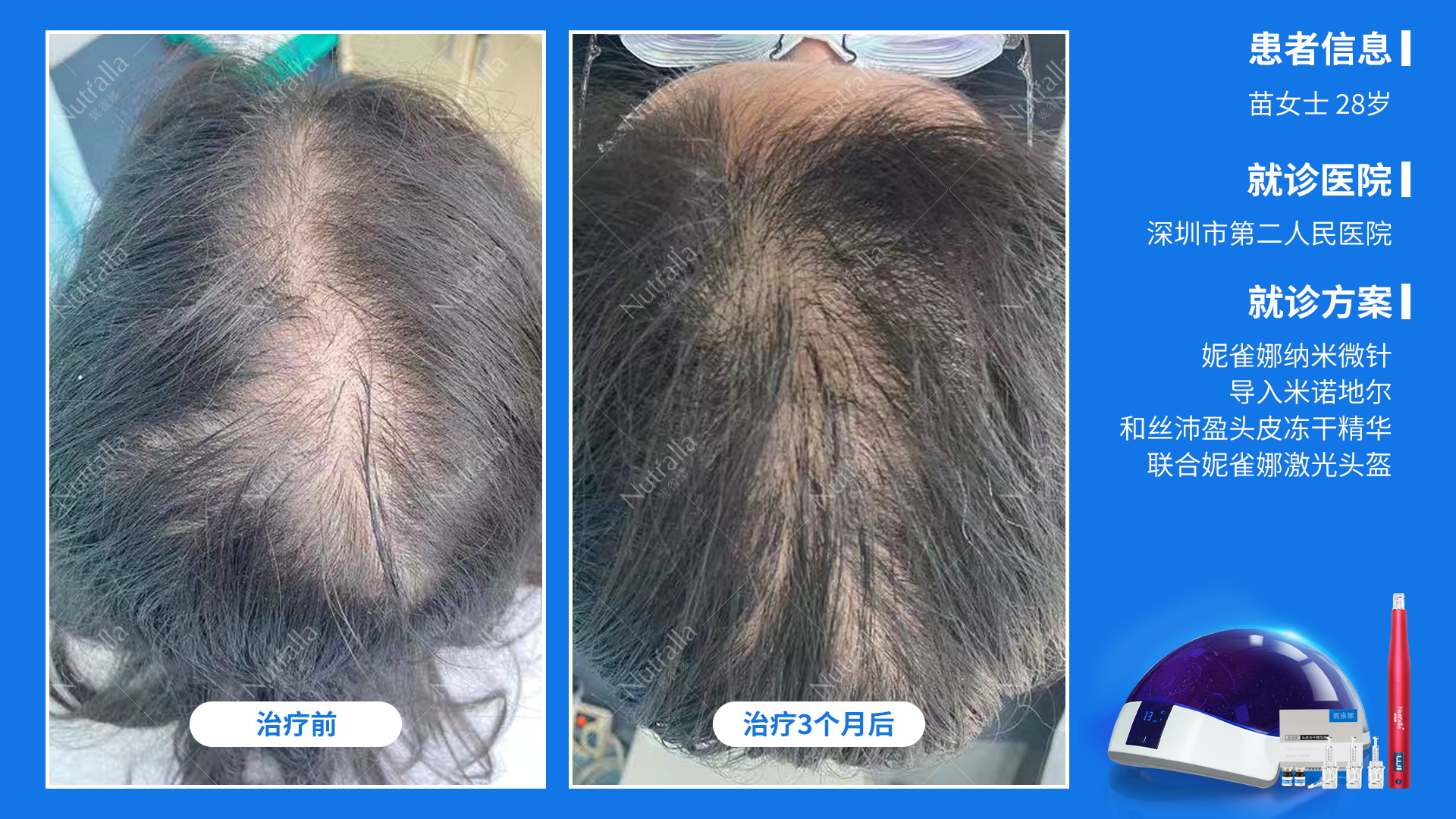 深圳市第二人民医院  女性 雄性激素脱发 28岁  外用5%米诺地尔+妮雀娜微针导入12次+激光头盔三个月治疗前后对比