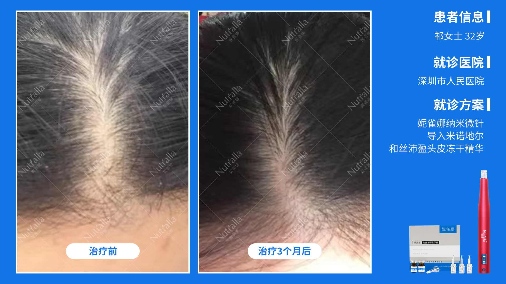 深圳市人民医院  女性 雄性激素脱发 32岁  外用5%米诺地尔+妮雀娜微针导入12次三个月治疗前后对比