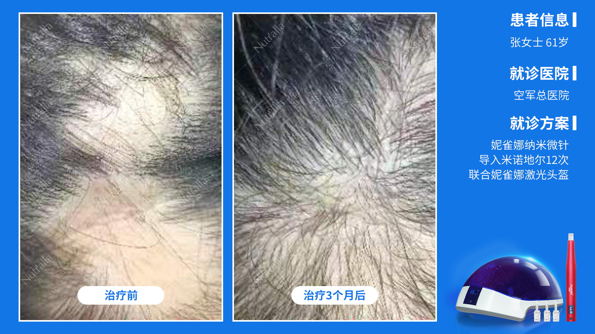 空总 张女士 61岁 斑秃 外用米诺地尔三个月+微针12次+红光三个月