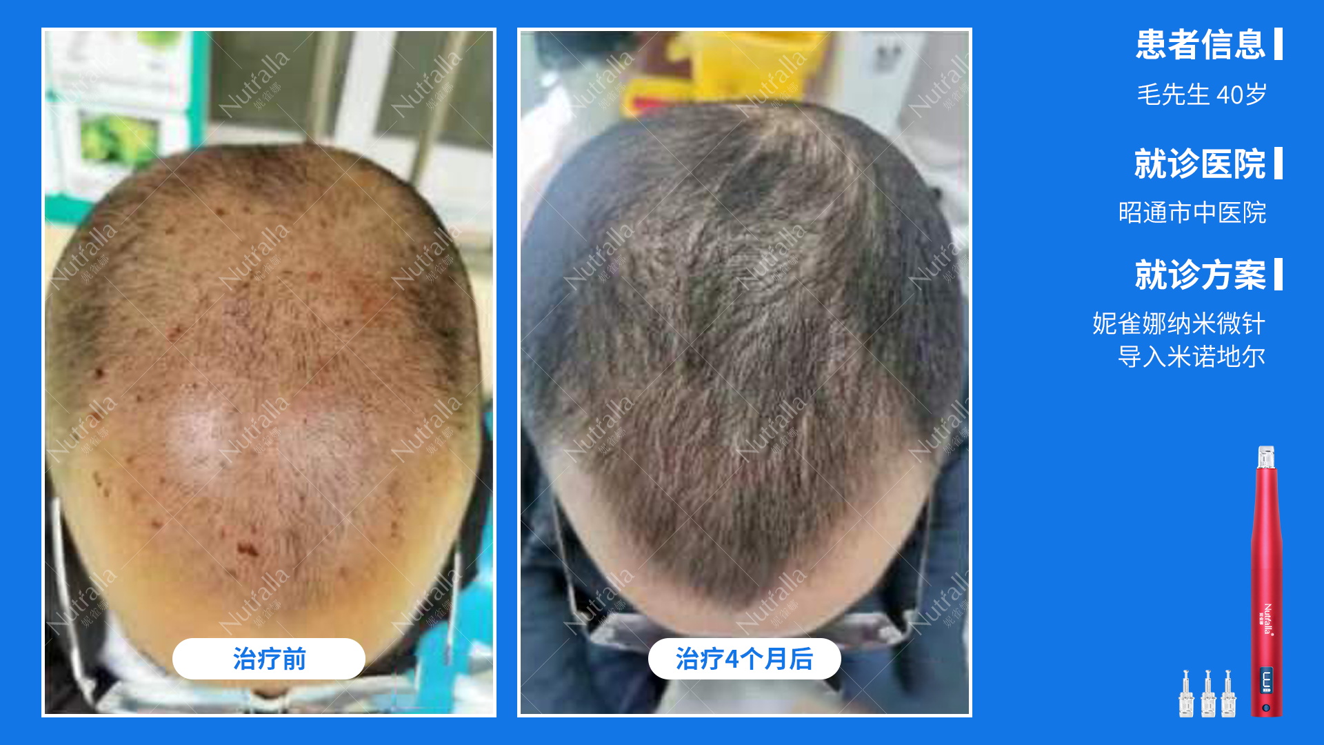 昭通市中医院，患者男性，40岁，诊断雄激素性秃发，治疗  米诺地尔+微针联合导入治疗4个月