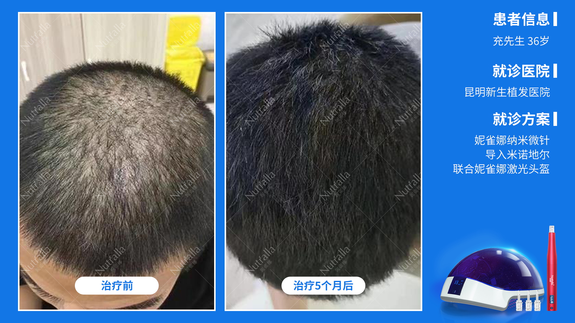 昆明新生植发医院药纳米微针治疗＋药物+激光生发帽5个月的男性患者效果