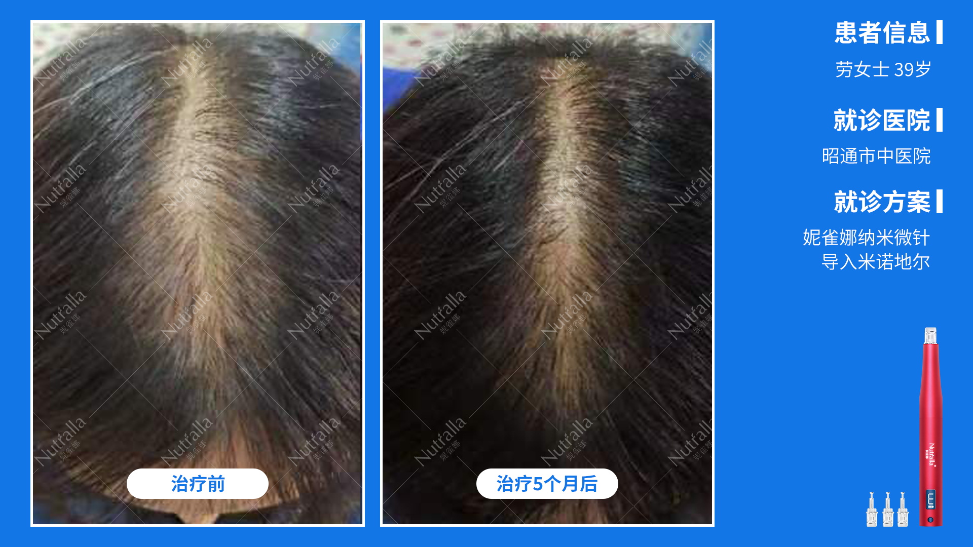 昭通市中医院  患者女性  39岁  诊断  雄激性脱发  治疗  米诺地尔  微针联合导入治疗5个月