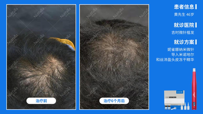 吉时微针植发  患者男  46岁  治疗方案：米诺地尔+微针+冻干精华液  6个月效果