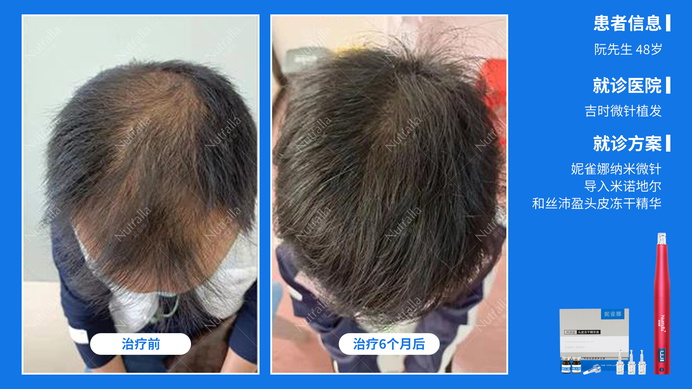 吉时微针植发  患者男  48岁  治疗方案：米诺地尔+微针+冻干精华液  6个月效果