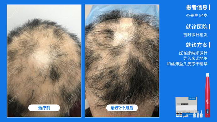 吉时微针植发  患者男  33岁  治疗方案：复方甘草酸苷片+米诺地尔+微针  2个月效果
