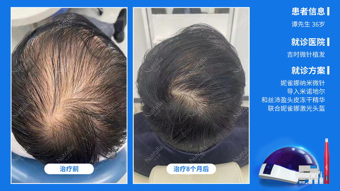 吉时微针植发  患者男  36岁  治疗方案：米诺地尔+微针+冻干精华液+妮雀娜低能量头盔  8个月效果