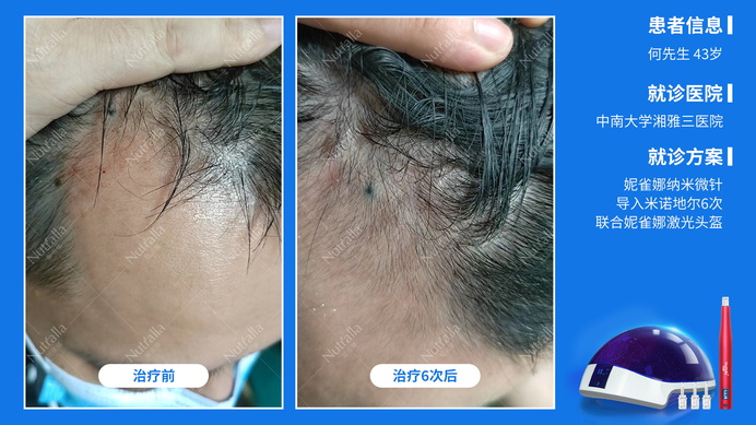 中南大学湘雅三医院  患者男  43岁  治疗方案：非那雄胺+米诺地尔+微针+妮雀娜低能量头盔  效果