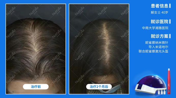 中南大学湘雅医院  患者女  40岁  治疗方案：米诺地尔+微针+妮雀娜低能量头盔 2个月效果