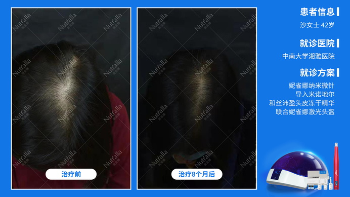 中南大学湘雅医院  患者女  42岁  治疗方案：米诺地尔+微针+冻干精华液+妮雀娜低能量头盔 8个月效果果