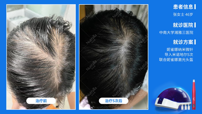 中南大学湘雅三医院  患者女  46岁  治疗方案：内服螺内酯+米诺地尔+微针5次+妮雀娜低能量头盔  效果