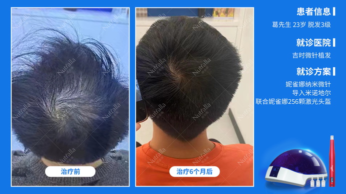 福州吉时微针植发  患者男  23岁  脱发3级  治疗方案：口服非那雄胺+米诺地尔+微针+256激光生发仪  6个月效果