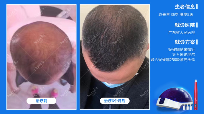 广东省人民医院  患者男  36岁  脱发5级  治疗方案：口服非那雄胺+米诺地尔+微针+256激光生发仪  6个月效果