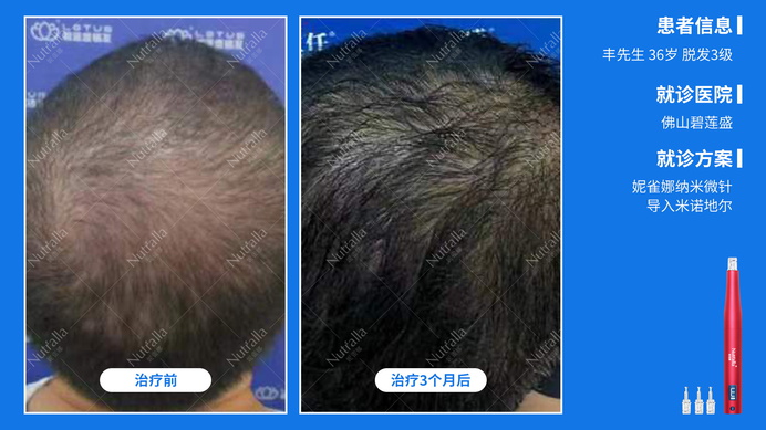 佛山碧莲盛  患者男  36岁  脱发3级  治疗方案：米诺地尔+微针  3个月效果