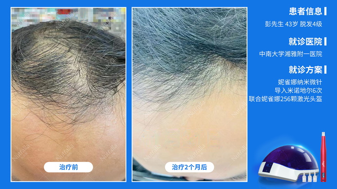 中南大学湘雅附一医院  患者男  43岁  脱发4级  治疗方案：口服非那雄胺+米诺地尔+微针（6次）+256激光生发仪  2个月效果