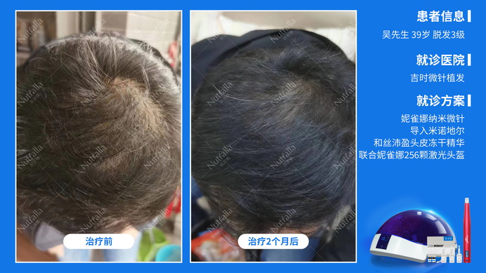 吉时微针植发  患者男  39岁  脱发3级  治疗方案：米诺地尔+微针(4次)+营养液+256激光生发仪  2个月效果