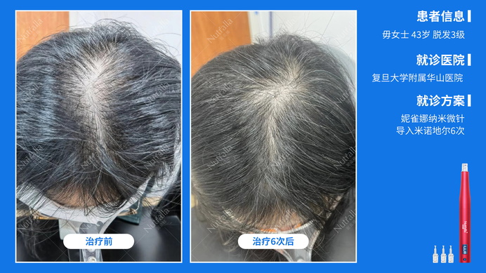 复旦大学附属华山医院  患者女  43岁  脱发3级  治疗方案：米诺地尔+微针（6次）  6次效果