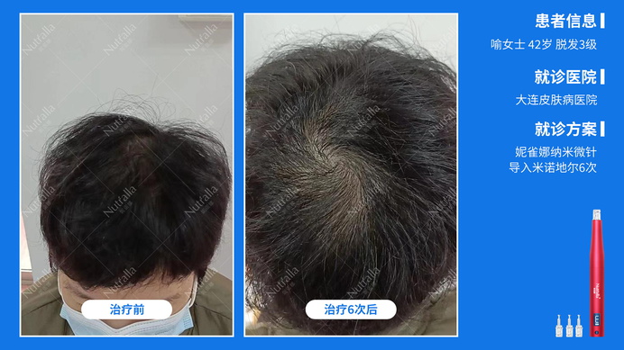 大连皮肤病医院  患者女  42岁  脱发3级  治疗方案：米诺地尔+微针(6次)  6次效果