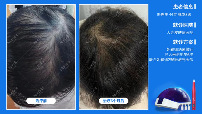 大连皮肤病医院  患者男  44岁  脱发3级  治疗方案：米诺地尔+微针(6次)+256激光生发仪  6个月效果