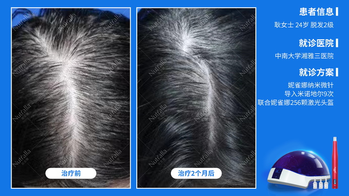 中南大学湘雅三医院  患者女  24岁  脱发2级  治疗方案：米诺地尔+微针（9次）+256激光生发仪  2个月效果