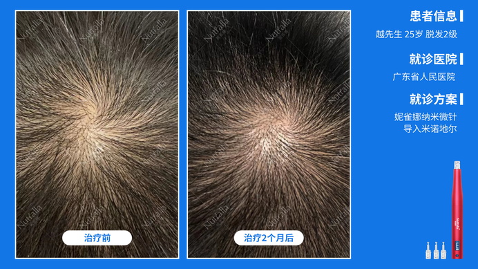 广东省人民医院  患者男  25岁  脱发2级  治疗方案：米诺地尔+微针  2个月效果
