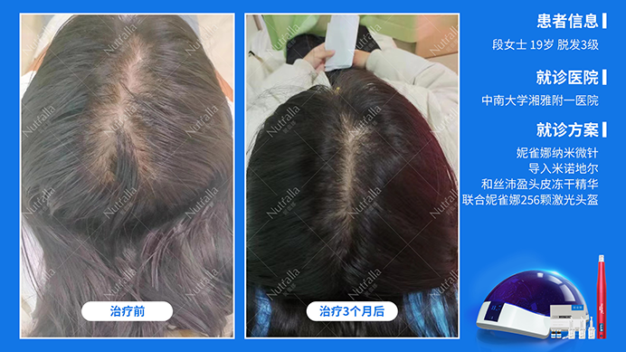 中南大学湘雅医院  女性   19岁 雄激素脱发  5%米诺地尔+妮雀娜头皮微针+妮雀娜激光治疗仪3个月前后对比图