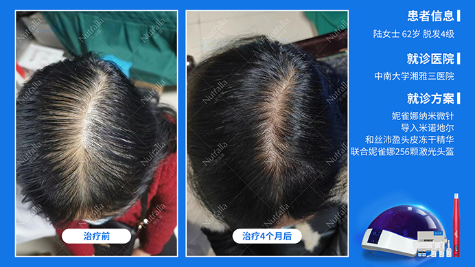 中南大学湘雅医院  男性   30岁 雄激素脱发  5%米诺地尔+妮雀娜头皮微针+妮雀娜激光治疗仪2个月前后对比图