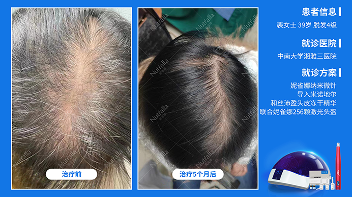 中南大学湘雅三医院  女性   39岁 雄激素脱发  5%米诺地尔+妮雀娜头皮微针+妮雀娜激光治疗仪5个月前后对比图