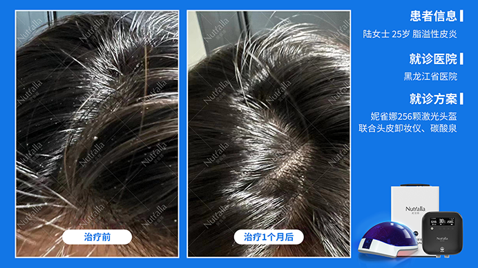 黑龙江省医院  患者女  25岁  脂溢性皮炎  治疗方案：妮雀娜256低能量激光治疗仪+水疗  治疗1个月效果