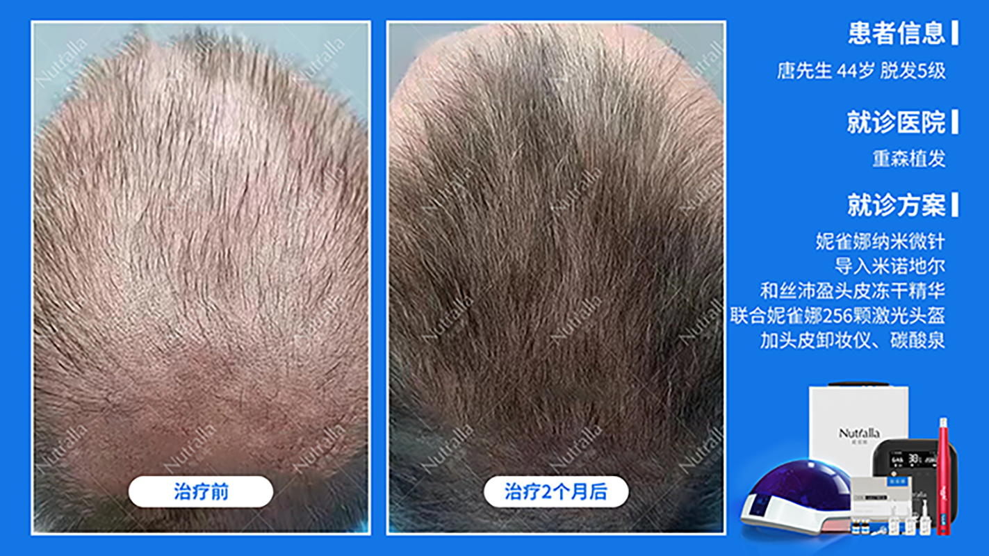 25岁秃头少年的自我救赎——植发及恢复实录（五）——植发九个月啦 - 知乎